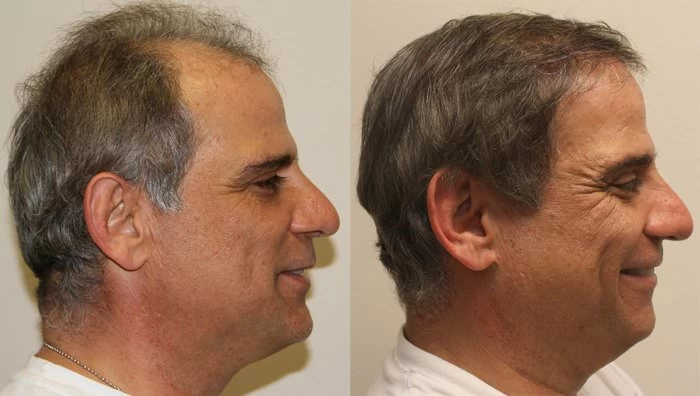 Patient p192 hair transplant before and after right view