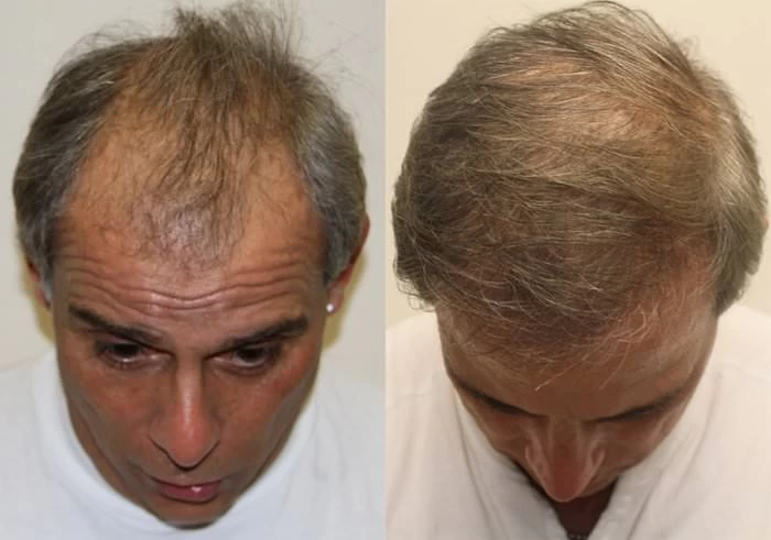 Patient p192 hair transplant before and after tilt view