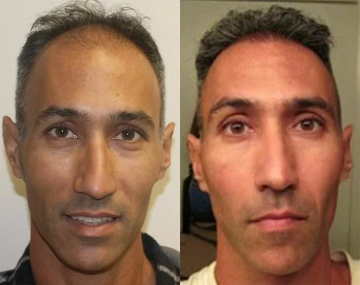 Shai Hair Transplant Before and After