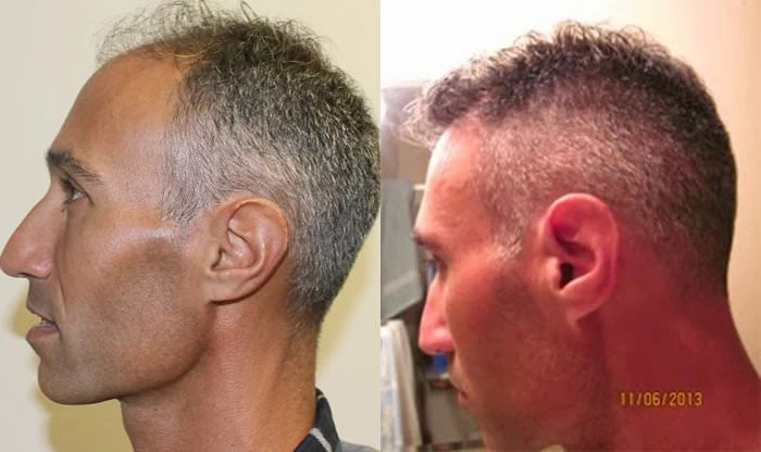 Patient p195 hair transplant before and after left view