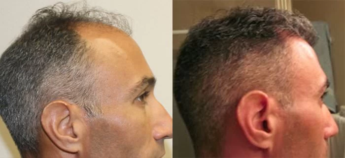 Patient p195 hair transplant before and after right view