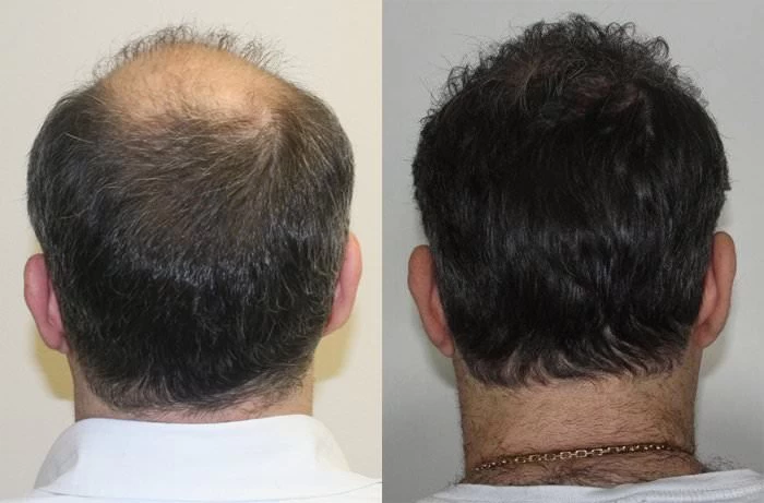 Patient p198 hair transplant before and after crown view
