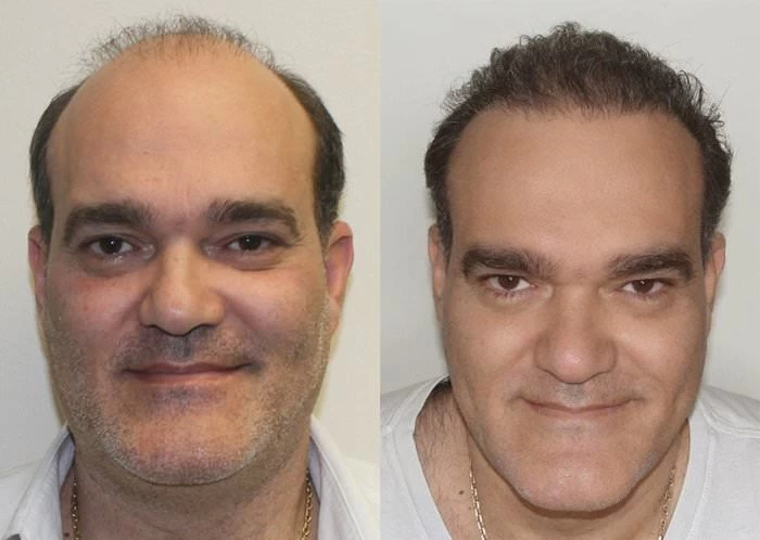 Felipe Hair Transplant Before and After