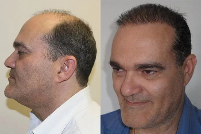 Patient p198 hair transplant before and after left view