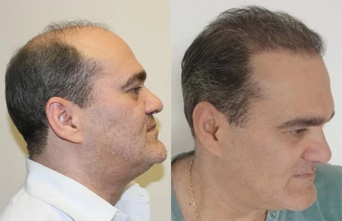 Patient p198 hair transplant before and after right view