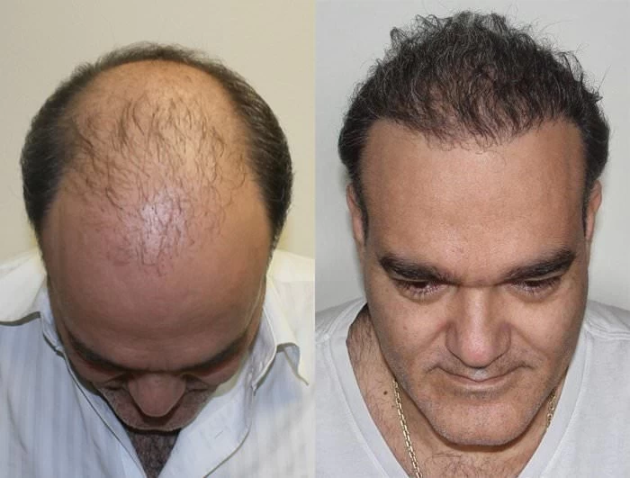 Patient p198 hair transplant before and after tilt view