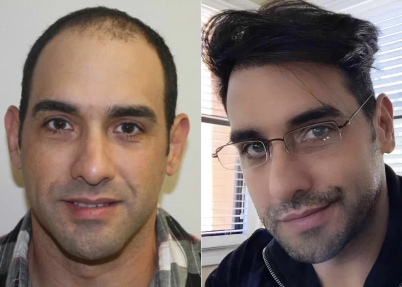 Oquel Hair Transplant Before and After