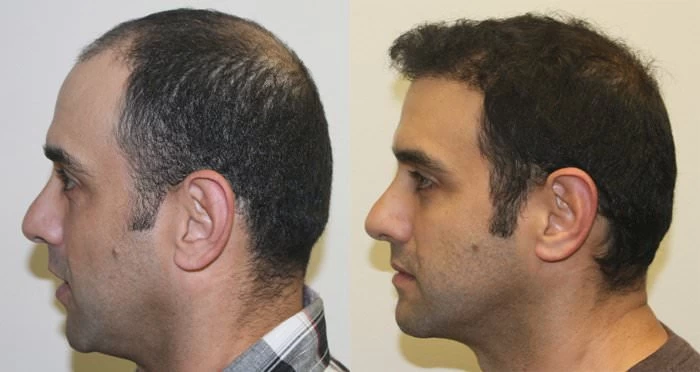 Patient p199 hair transplant before and after left view