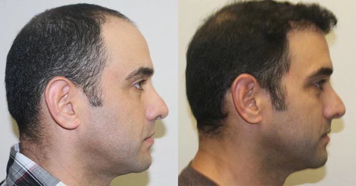 Patient p199 hair transplant before and after right view