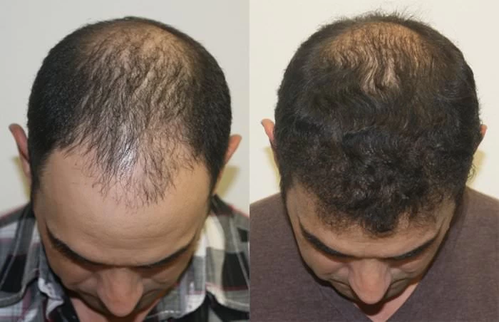 Patient p199 hair transplant before and after tilt view