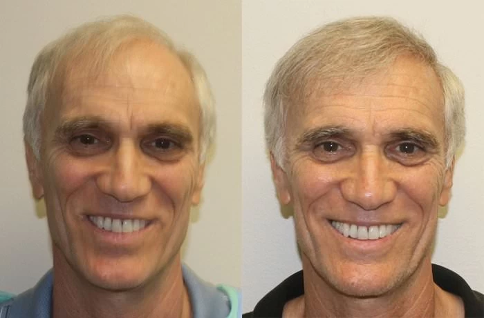 Jim Hair Transplant Before and After