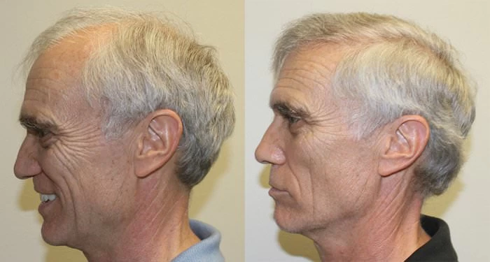 Patient p200 hair transplant before and after left view