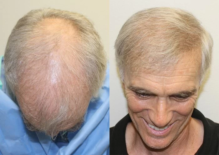 Patient p200 hair transplant before and after tilt view