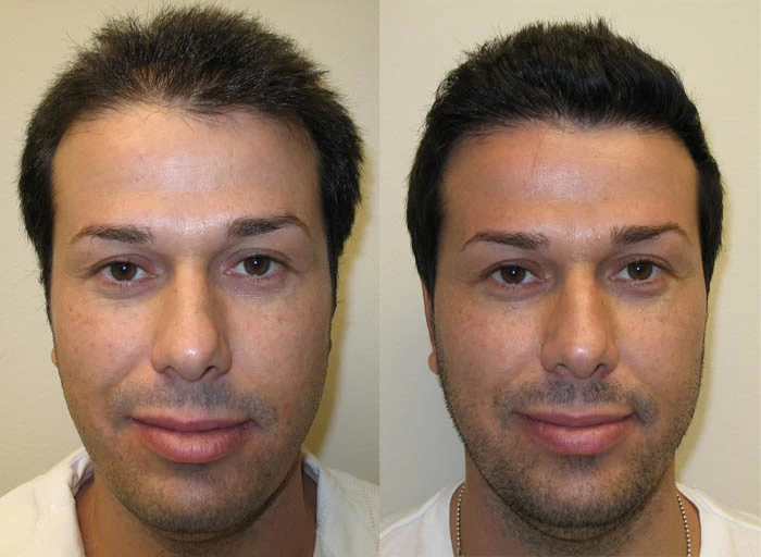 Noam Hair Transplant Before and After