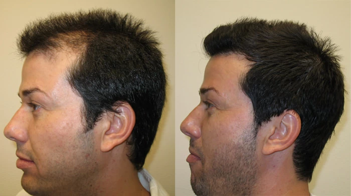 Patient p20 hair transplant before and after left view