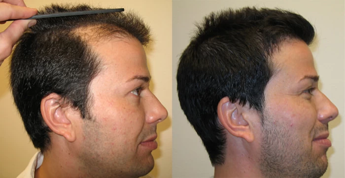 Patient p20 hair transplant before and after right view