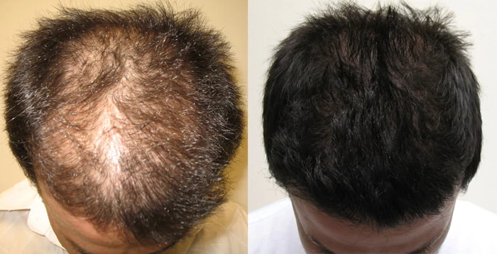 Patient p20 hair transplant before and after tilt view