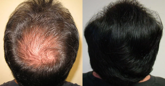 Patient p21 hair transplant before and after crown view
