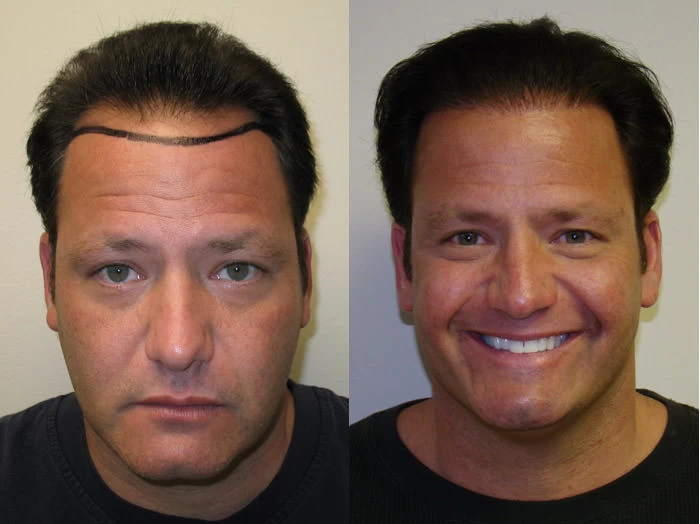 Cary Hair Transplant Before and After