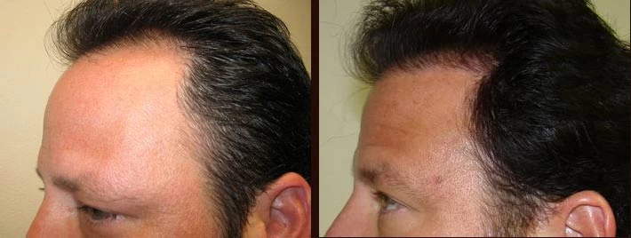 Patient p21 hair transplant before and after left view
