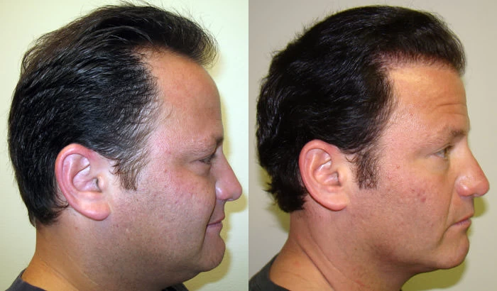 Patient p21 hair transplant before and after right view