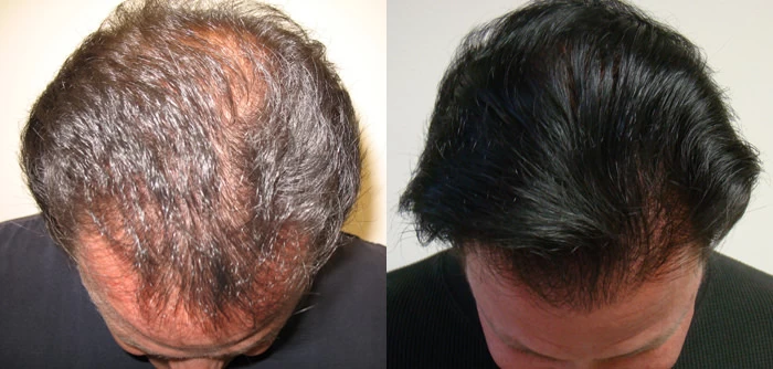 Patient p21 hair transplant before and after tilt view