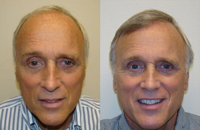 Tom Hair Transplant Before and After