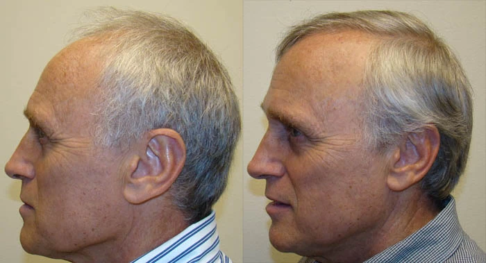 Patient p25 hair transplant before and after left view