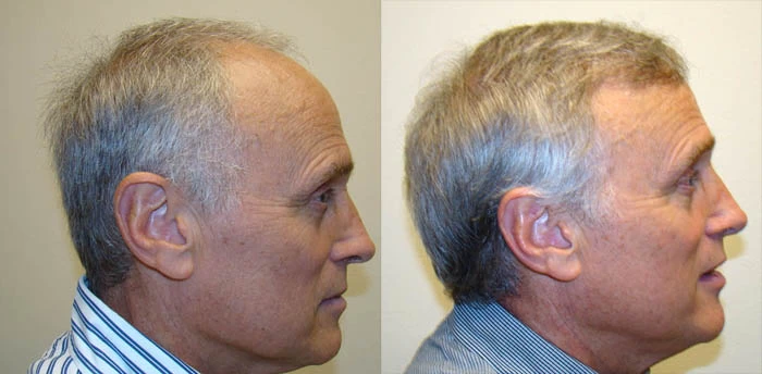 Patient p25 hair transplant before and after right view