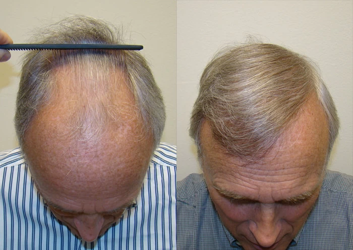 Patient p25 hair transplant before and after tilt view