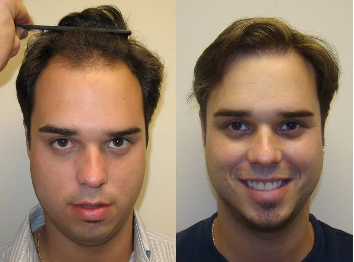 Rod Hair Transplant Before and After