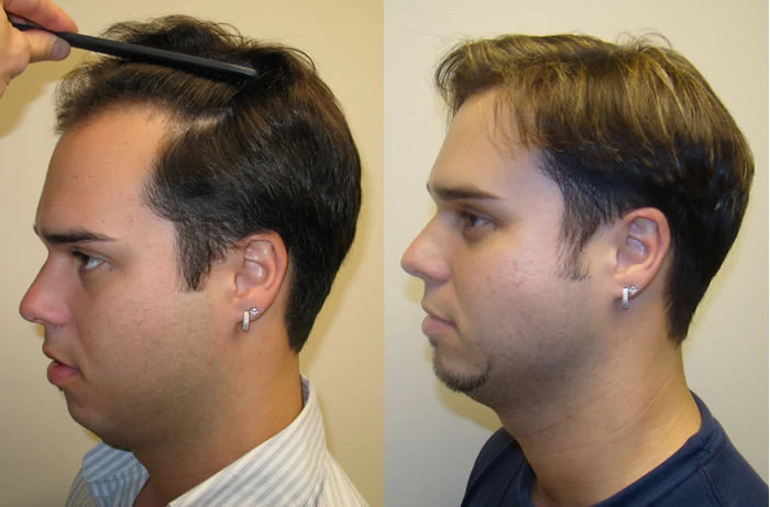 Patient p28 hair transplant before and after left view