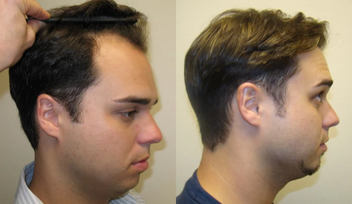 Patient p28 hair transplant before and after right view