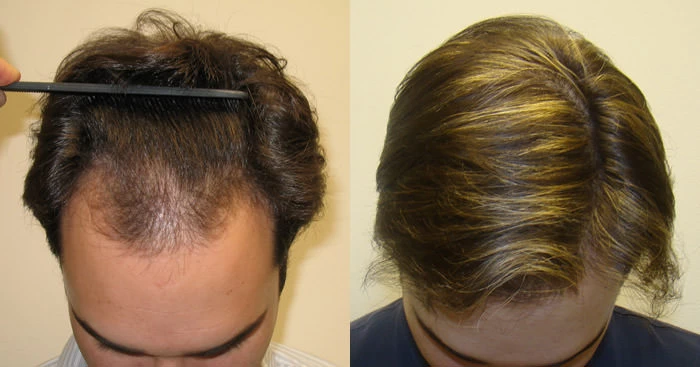 Patient p28 hair transplant before and after tilt view