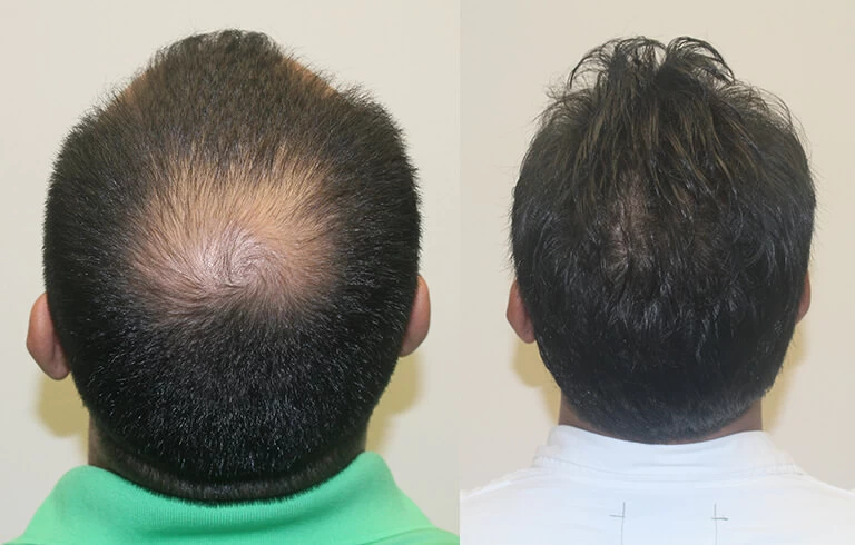 Patient p301 hair transplant before and after crown view