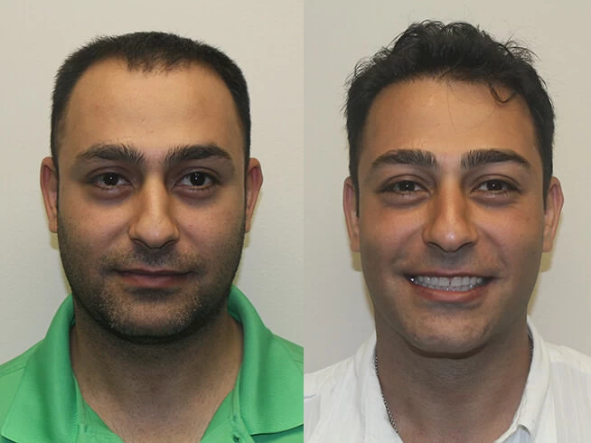 Amir Hair Transplant Before and After