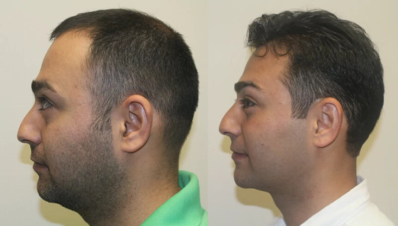 Patient p301 hair transplant before and after left view