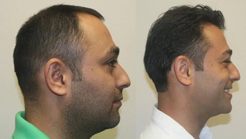 Patient p301 hair transplant before and after right view