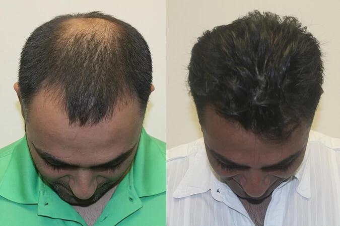 Patient p301 hair transplant before and after tilt view