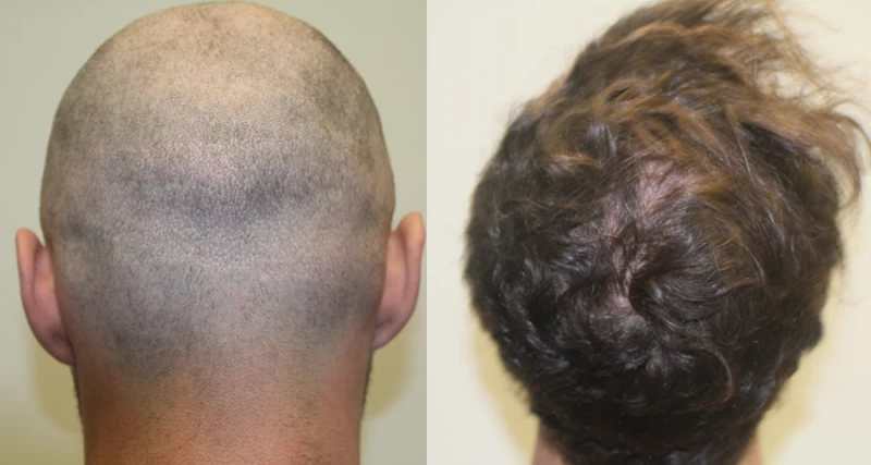Patient p302 hair transplant before and after crown view
