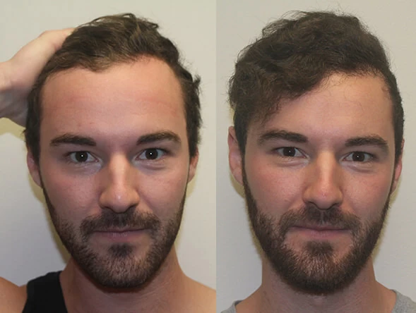 Casey Hair Transplant Before and After