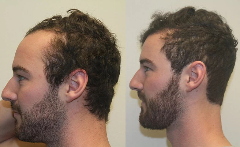 Patient p302 hair transplant before and after left view