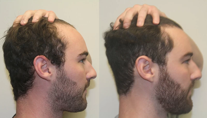 Patient p302 hair transplant before and after right view