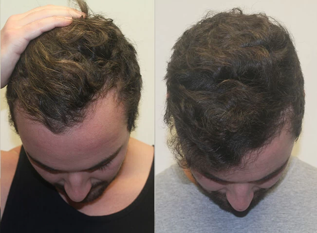 Patient p302 hair transplant before and after tilt view