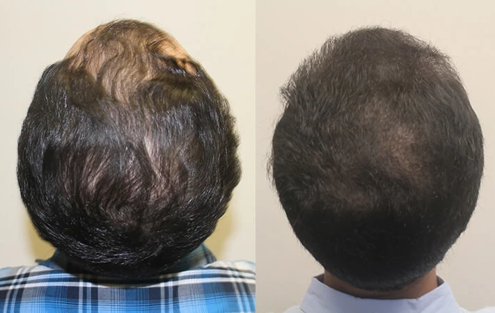 Patient p303 hair transplant before and after crown view