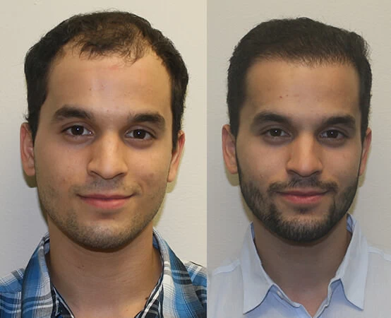 Johnathan Hair Transplant Before and After
