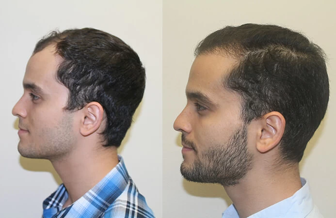 Patient p303 hair transplant before and after left view