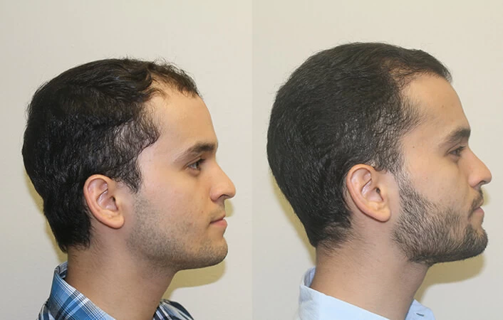 Patient p303 hair transplant before and after right view