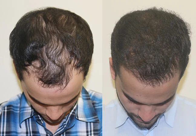 Patient p303 hair transplant before and after tilt view