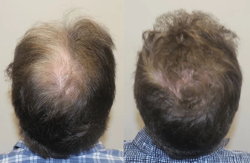 Patient p305 hair transplant before and after crown view